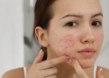 Nguyên nhân khiến da mụn mãi không khỏi