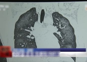 Chàng trai 20 tuổi phổi trắng xóa vì “chiêu” chống nắng của nhiều người